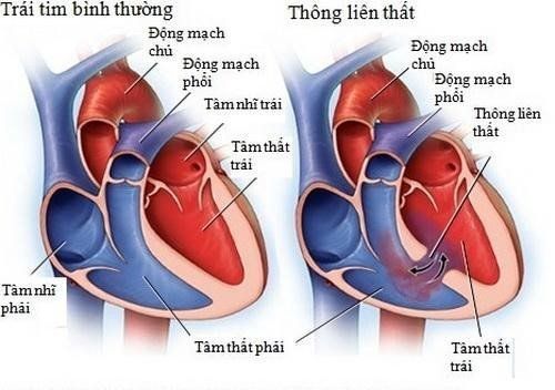 
Hình ảnh thông liên thất trong bệnh tim bẩm sinh
