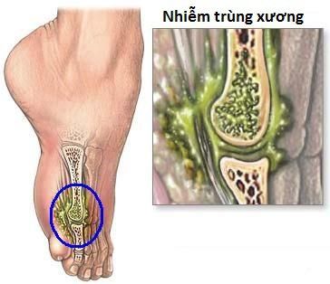 
Nhiễm trùng xương có thể gây viêm tủy xương
