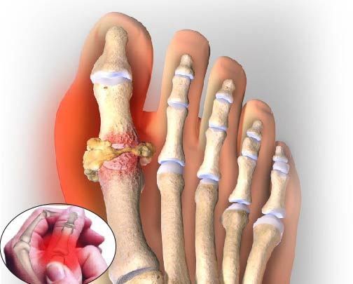 Gout Nặng: Nguyên Nhân, Triệu Chứng và Cách Điều Trị Hiệu Quả