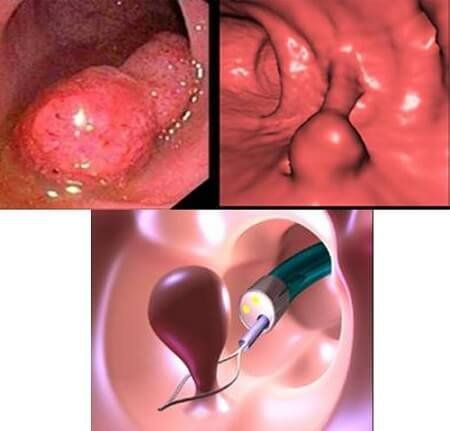 
Một số hình ảnh polyp buồng tử cung
