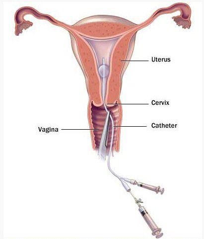 
Tiêm chất cản quang chứa thuốc nhuộm vào tử cung bằng ống nhựa mỏng
