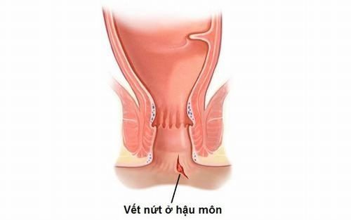 
Quá trình sinh nở hậu môn bị co thắt đột ngột, táo bón gây nứt kẽ hậu môn
