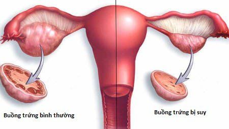 
Tình trạng suy buồng trứng có thể gây vô kinh nguyên phát
