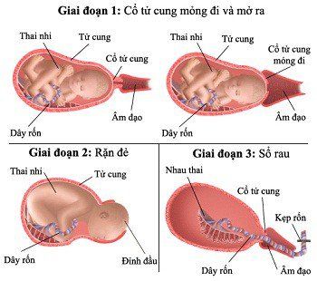 4. Những biến chứng có thể gặp trong quá trình chuyển dạ