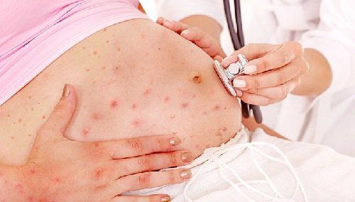 Rubella infection during pregnancy, will the baby be infected?