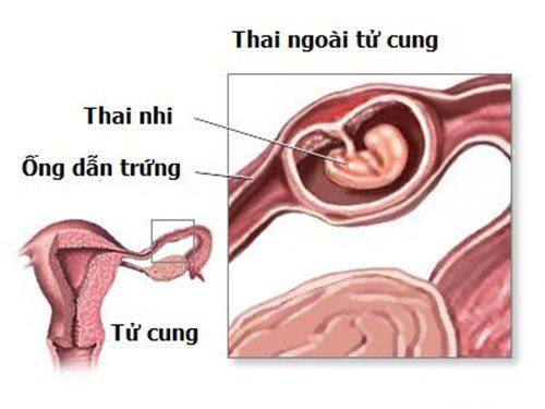 When is surgery used to treat an ectopic pregnancy?