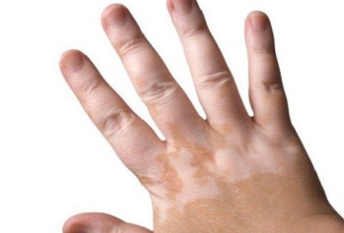 Vitiligo spots appear curable?