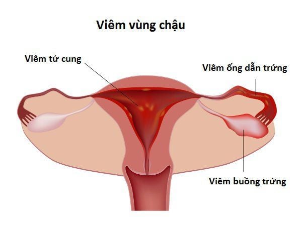 7. Phòng ngừa viêm vùng chậu mãn tính