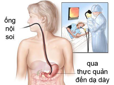 
Nội soi dạ dày giúp đánh giá mức độ tiến triển của loét dạ dày tá tràng do vi khuẩn HP gây ra
