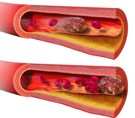 Dangerous complications of amniotic fluid embolism