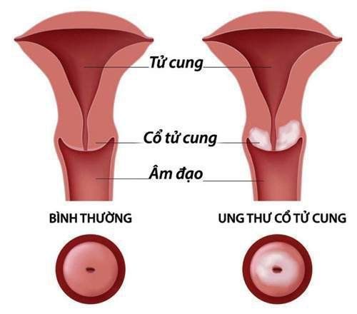 
Ung thư cổ tử cung là bệnh nguy hiểm ở nữ giới
