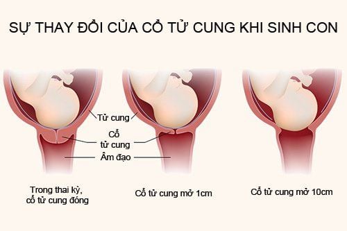 
Dấu hiệu chuyển dạ là khi nút nhầy bị bung ra và thoát ra ngoài cửa âm đạo một chút nhầy nhớt màu hồng
