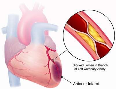 
Phình và bóc tách động mạch chủ là hai bệnh lý động mạch chủ gây nguy cơ tử vong
