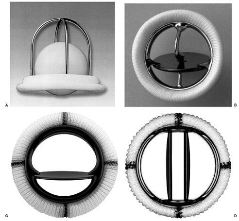 3 common types of artificial heart valves and pros and cons