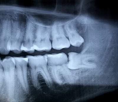 What does wisdom teeth do? When to spit?