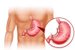 What is moderate antral congestion?