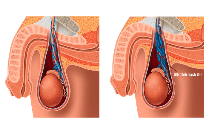 4. Phương Pháp Điều Trị Giãn Tĩnh Mạch Thừng Tinh Nhẹ