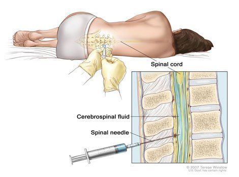 Possible risks of lumbar puncture