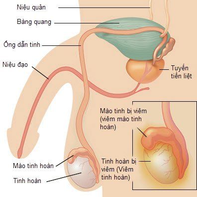 
Viêm tinh hoàn là một bệnh do vi khuẩn hoặc virus gây ra với các biểu hiện sưng đau ở một hoặc cả hai tinh hoàn trong bìu
