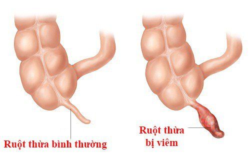 
Trẻ bị viêm ruột thừa không được đưa đi khám kịp thời có thể đe dọa tính mạng.
