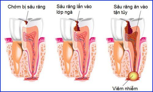 
Sâu răng có thể gây nên viêm tủy xương
