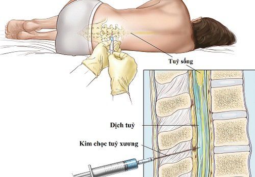 
Chọc dò dịch não tủy
