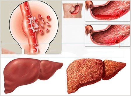 Dangerous complications of cirrhosis