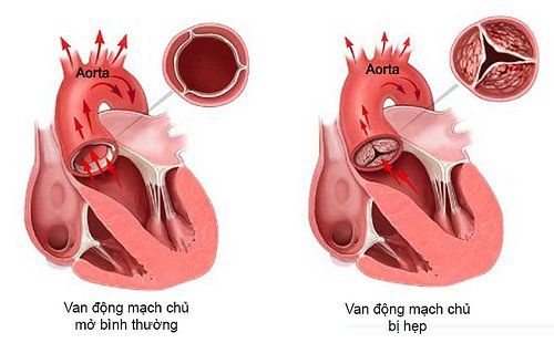 
Hình ảnh mô tả tình trạng hẹp van động mạch chủ
