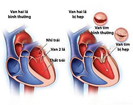 Is asymptomatic aortic stenosis dangerous?