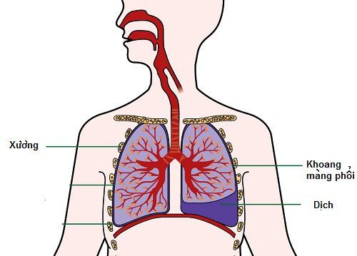 
Tràn dịch màng phổi là nguyên nhân gây suy hô hấp có tăng CO2 máu
