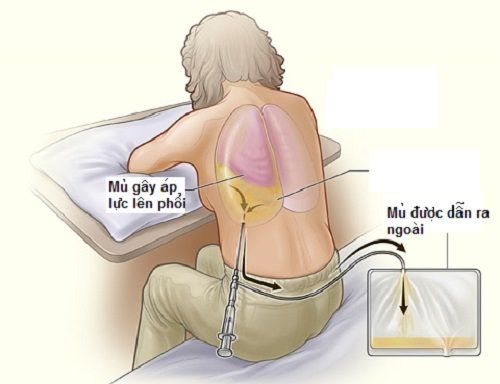 
Chọc hút dịch màng phổi và dẫn lưu dịch
