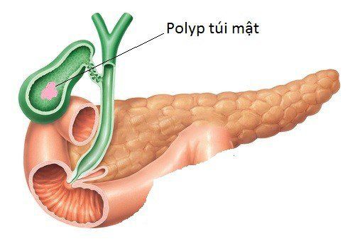 
Polyp túi mật
