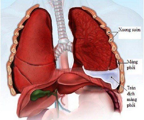 
Đặc điểm của viêm phổi cấp (ADRS) dẫn đến hiện tượng tràn dịch phổi và giải phóng các cytokines vào trong mạch máu
