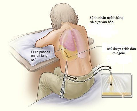 
Image of pleural fluid aspiration
