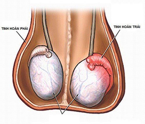 
Viêm tinh hoàn là biến chứng phổ biến nhất của quai bị ở nam giới
