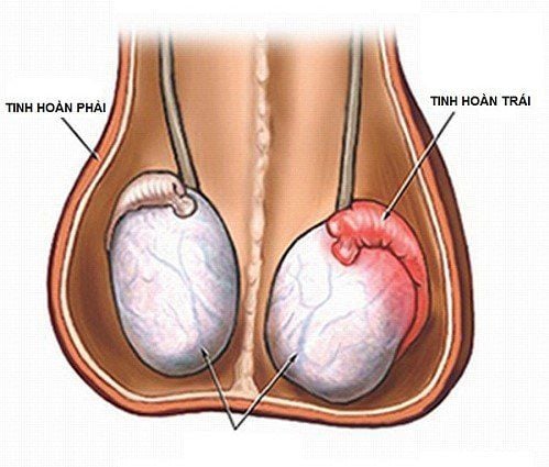 
Viêm tinh hoàn ở bé trai là biến chứng nguy hiểm của quai bị, có thể gây vô sinh
