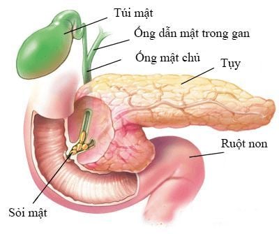 
Viêm túi mật
