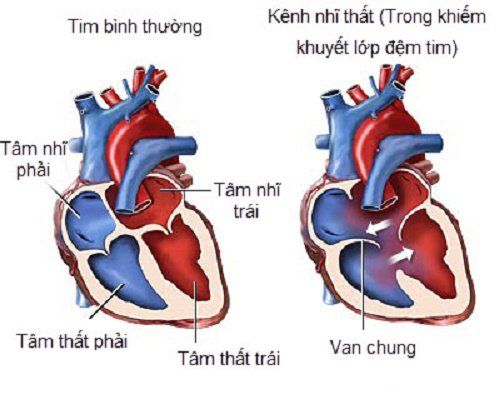 
Hình ảnh kênh nhĩ thất trong khiếm khuyết lớp đệm tim
