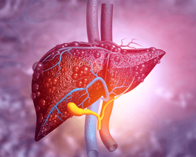 What does F2-F3 liver fibrosis mean?