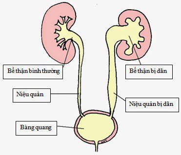 
Chụp lớp cắt thì muộn cho bệnh nhân bị giãn đài bể thận
