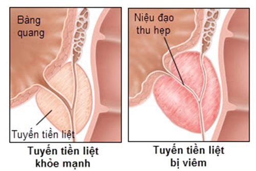 
Điều trị ung thư tuyến tiền liệt hoặc sưng tuyến tiền liệt
