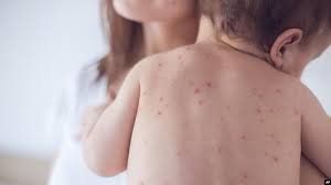 How long is the incubation period for measles?