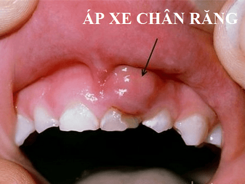 
Áp xe chân răng do biến chứng của bệnh viêm cuống chân răng
