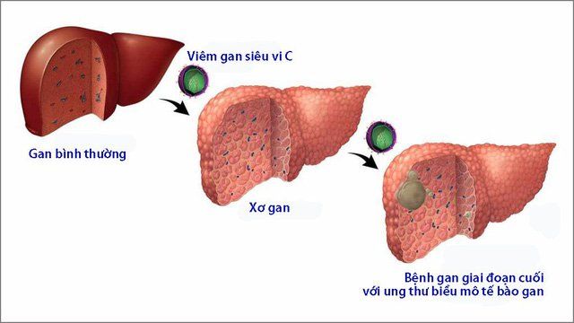 6. Tác động của môi trường và chế độ dinh dưỡng trong việc phòng chống ung thư gan