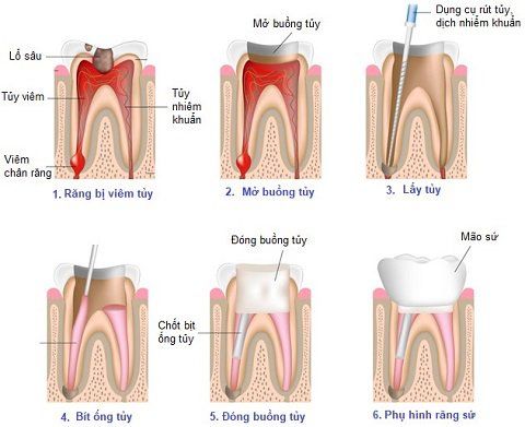 
Các bước điều trị viêm tủy răng
