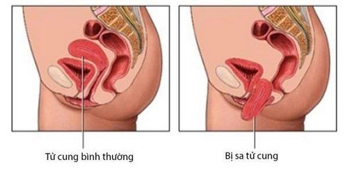 
Hình ảnh tử cung bị sa
