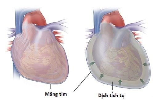 Bệnh viêm màng ngoài tim co thắt có thể dẫn tới suy tim