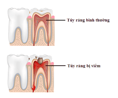 
Tủy răng bị viêm
