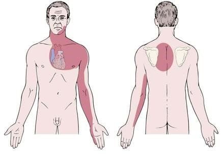 
Vị trí và hướng lan của cơn đau thắt ngực do bệnh động mạch vành
