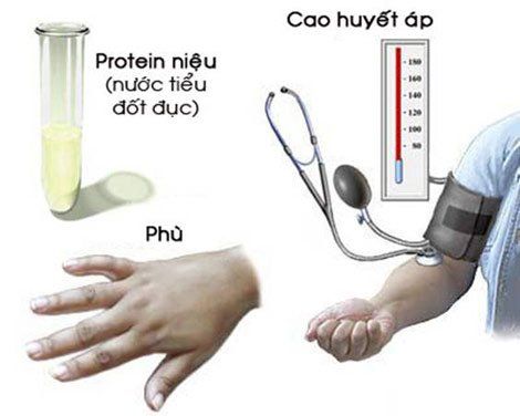 
Huyết áp và protein niệu tăng, phù toàn thân là dấu hiệu điển hình của tiền sản giật
